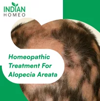Alopecia areata disease